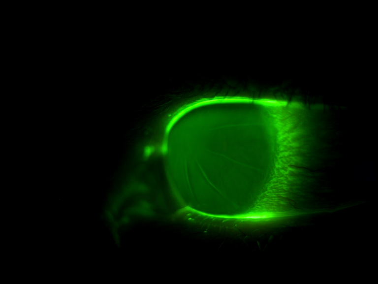 EyeNews_2nd - Keyur Patel