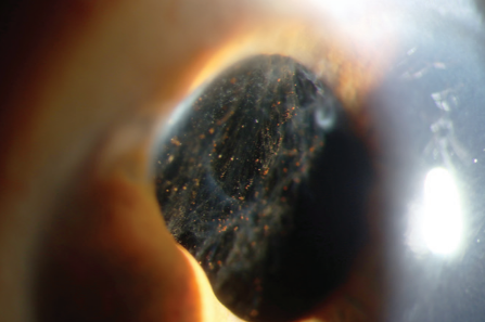 EyeNews_shortlist2_vitreousintheAC