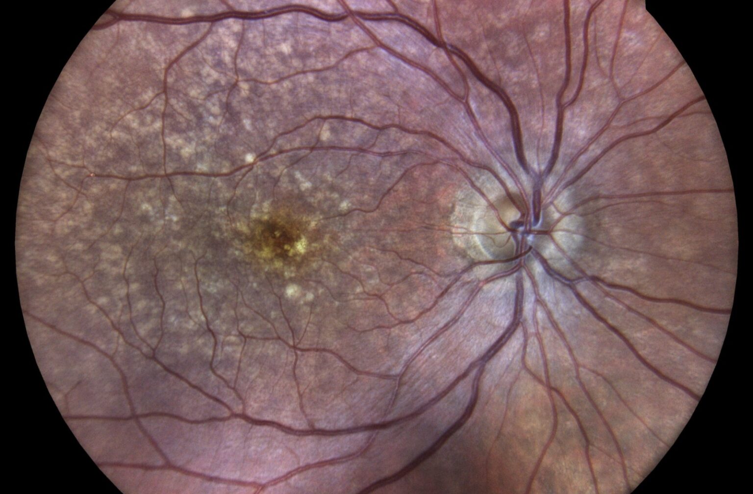 Understanding and managing Dry AMD: A new era in treatment
