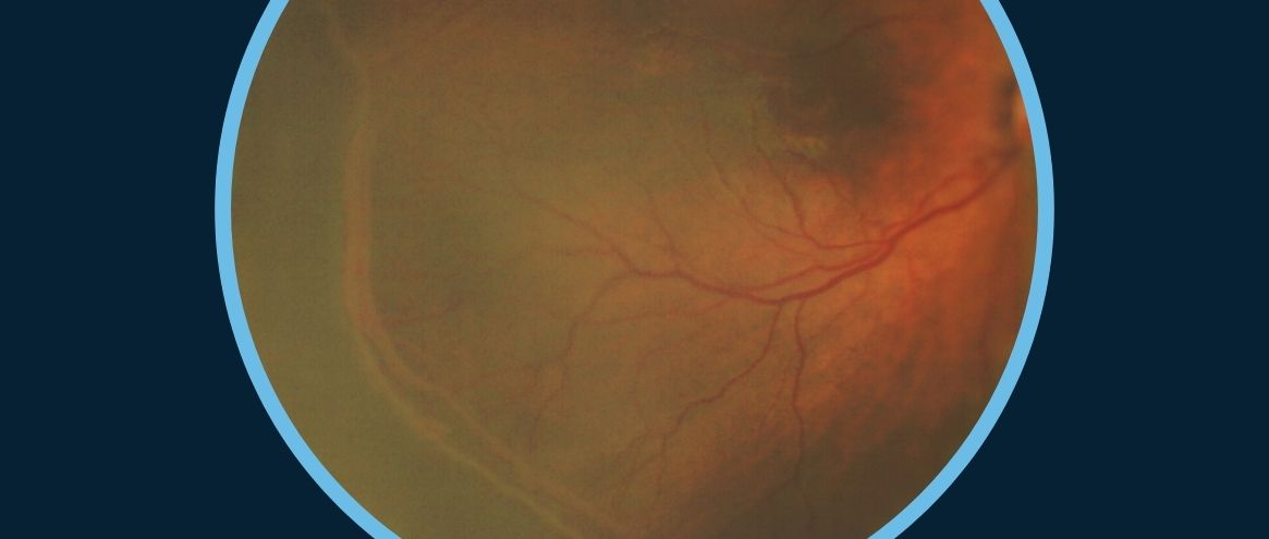 ROP screening: The clinical and educational value of paediatric retinal imaging using binocular indirect ophthalmoscopy
